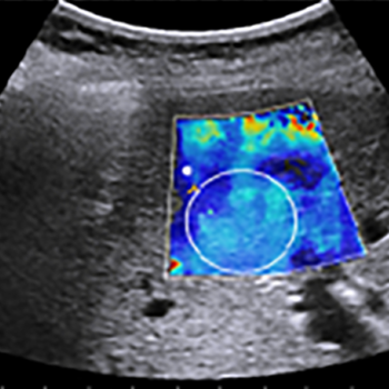 The example shear-wave elastograph of liver fibrosis staging shows the vibrant color-coded area enabled by SWE Assist.  